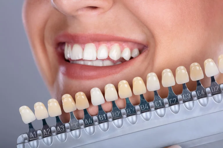 Carillas Dentales