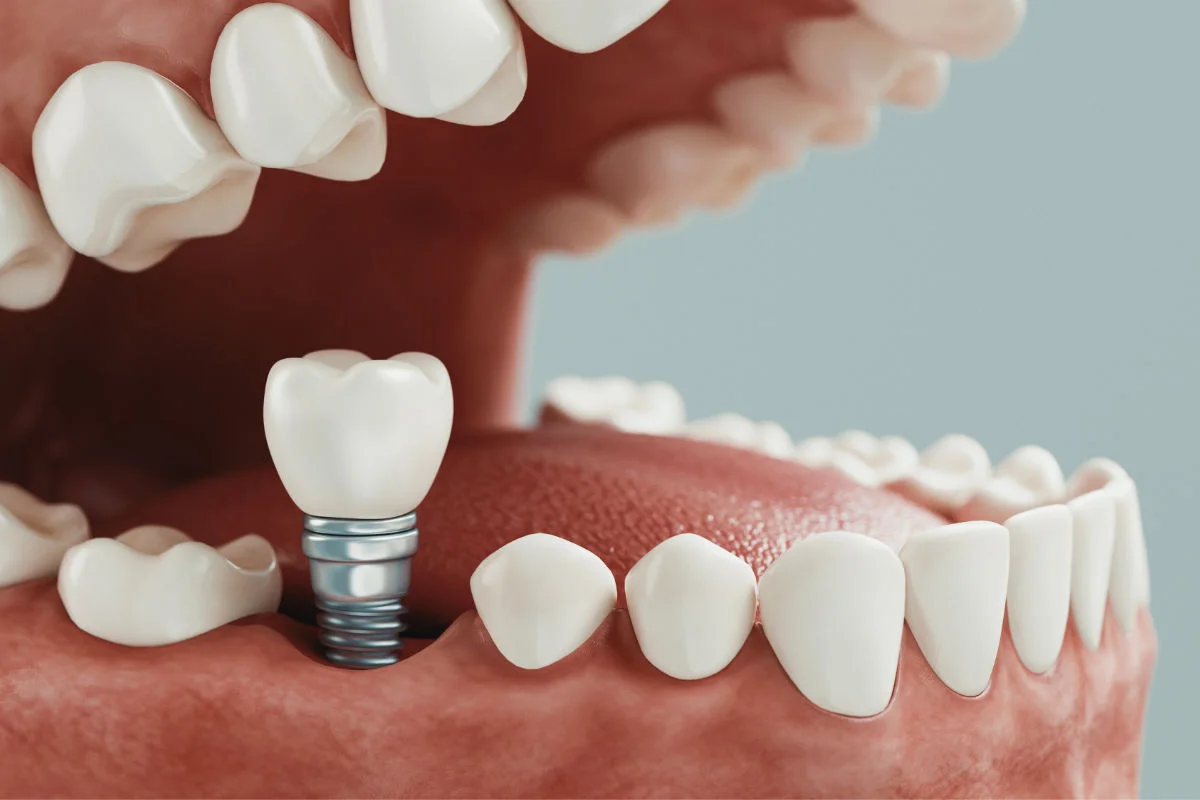 Implantes Dentales
