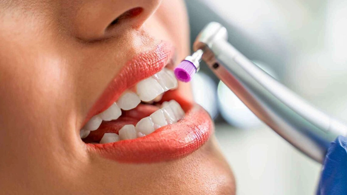 Limpiezas Dentales